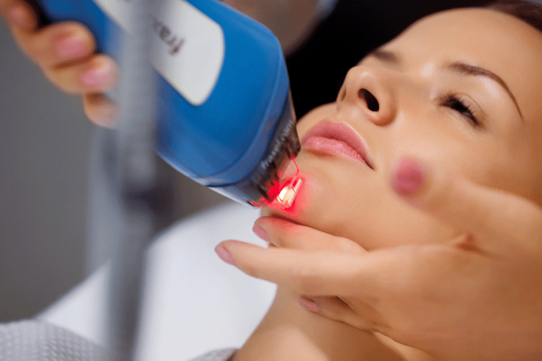 Întinerirea cu laser a pielii feței