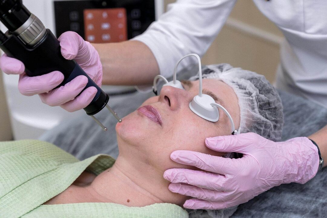 Procedura ablativă cu laser pentru întinerirea pielii