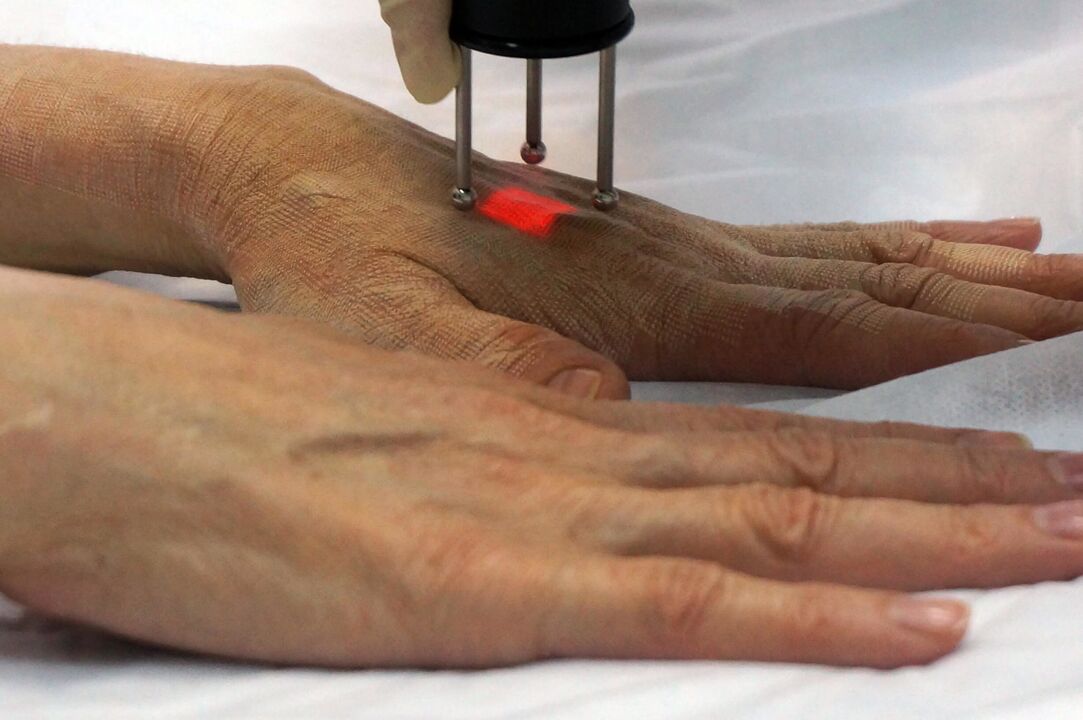 Întinerirea cu laser a mâinilor folosind o metodă non-ablativă