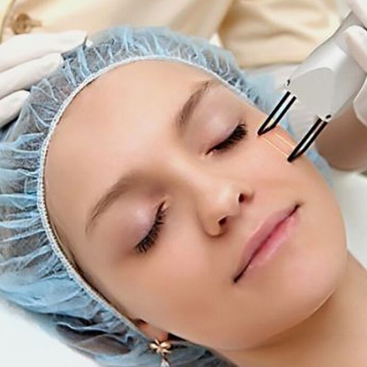 Rejuvenarea fracțională laser