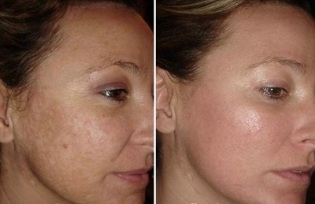 Întinerire facială cu laser înainte de fotografii și după